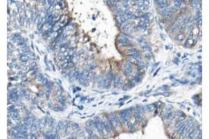 ABIN6267434 at 1/100 staining human Thyroid cancer tissue sections by IHC-P.