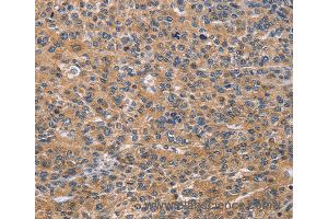 Immunohistochemistry of Human lung cancer using NCR2 Polyclonal Antibody at dilution of 1:60 (NKp44/NCR2 antibody)