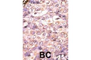 Formalin-fixed and paraffin-embedded human cancer tissue reacted with the primary antibody, which was peroxidase-conjugated to the secondary antibody, followed by AEC staining. (DUSP7 antibody  (N-Term))