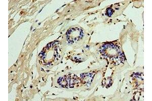 Immunohistochemistry of paraffin-embedded human breast cancer using ABIN7156290 at dilution of 1:100 (IMPDH2 antibody  (AA 215-514))