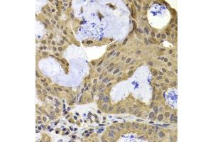 Immunohistochemistry of paraffin-embedded human oophoroma using TERF2IP antibody at dilution of 1:100 (40x lens). (RAP1 antibody)