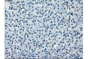 Immunohistochemical staining of paraffin-embedded Adenocarcinoma of breast tissue using anti-BUB1B mouse monoclonal antibody. (BUB1B antibody)