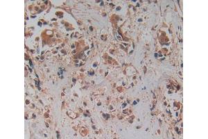 Used in DAB staining on fromalin fixed paraffin- embedded breast cancer tissue