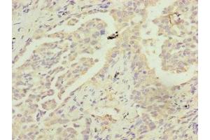 Immunohistochemistry of paraffin-embedded human lung cancer using ABIN7142260 at dilution of 1:100 (MRPS22 antibody  (AA 1-360))