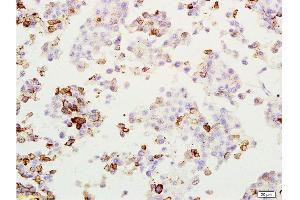 Formalin-fixed and paraffin embedded rat lung melanoma labeled with Anti-MAGE-1 Polyclonal Antibody, Unconjugated  at 1:200, followed by conjugation to the secondary antibody and DAB staining (MAGEA1 antibody  (AA 101-200))