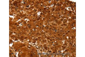 Immunohistochemistry of Human esophagus cancer using NCOR1 Polyclonal Antibody at dilution of 1:60