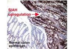 Immunohistochemical staining of SIAH2 on human colorectal adenocarcinoma with SIAH2 monoclonal antibody, clone 24E6H3 . (SIAH2 antibody  (AA 1-100))