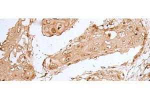 Immunohistochemistry of paraffin-embedded Human esophagus cancer tissue using HOXC9 Polyclonal Antibody at dilution of 1:35(x200) (HOXC9 antibody)