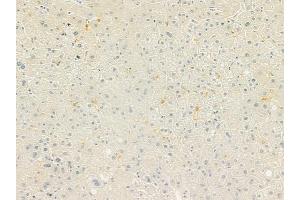ABIN6260737 and ABIN6279257 at 1/100 staining human hepatocellular carcinoma by IHC-P.