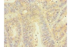 Immunohistochemistry of paraffin-embedded human colon cancer using ABIN7172830 at dilution of 1:100 (TGFB3 antibody  (AA 24-300))