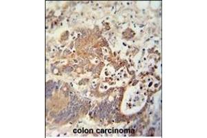 CHCHD2 antibody (Center) (ABIN654013 and ABIN2843939) immunohistochemistry analysis in formalin fixed and paraffin embedded human colon carcinoma followed by peroxidase conjugation of the secondary antibody and DAB staining. (CHCHD2 antibody  (AA 74-103))