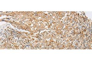 Immunohistochemistry of paraffin-embedded Human cervical cancer tissue using MBOAT4 Polyclonal Antibody at dilution of 1:30(x200) (MBOAT4 antibody)