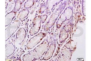 Formalin-fixed and paraffin embedded human gastric carcinoma tissue labeled with Anti-CENPA Polyclonal Antibody, Unconjugated (ABIN750113) at 1:200 followed by conjugation to the secondary antibody and DAB staining (CENPA antibody  (AA 65-140))