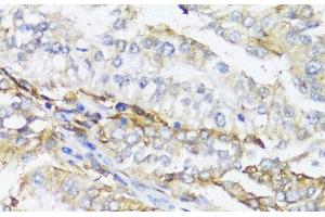 Immunohistochemistry of paraffin-embedded Human colon carcinoma using HLA-DPB1 Polyclonal Antibody at dilution of 1:100 (40x lens). (HLA-DPB1 antibody)