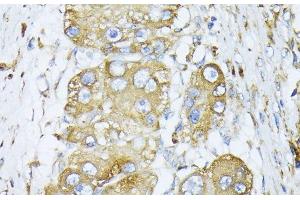 Immunohistochemistry of paraffin-embedded Human liver cancer using CALR Polyclonal Antibody at dilution of 1:100 (40x lens).