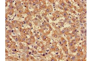 Immunohistochemistry of paraffin-embedded human liver cancer using ABIN7153167 at dilution of 1:100 (FFAR3 antibody  (AA 280-346))