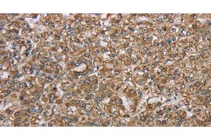 Immunohistochemistry of paraffin-embedded Human prostate cancer using CERS4 Polyclonal Antibody at dilution of 1:35 (LASS4 antibody)