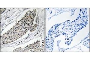 Immunohistochemistry analysis of paraffin-embedded human breast carcinoma tissue, using KCNAB3 Antibody. (KCNAB3 antibody  (AA 293-342))