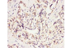 IHC-P: VEGF antibody testing of human lung cancer tissue (VEGFA antibody  (AA 27-191))