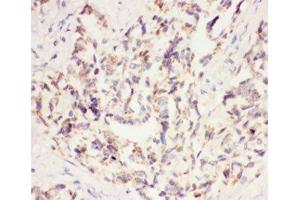 IHC-P: VEGF antibody testing of human lung cancer tissue