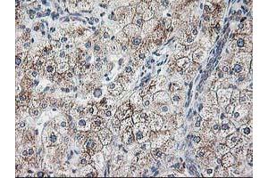 Immunohistochemical staining of paraffin-embedded Human liver tissue using anti-RPN1 mouse monoclonal antibody. (RPN1 antibody)