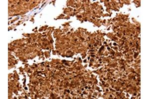 The image on the left is immunohistochemistry of paraffin-embedded Human lung cancer tissue using ABIN7128966(CLEC4A Antibody) at dilution 1/15, on the right is treated with fusion protein.