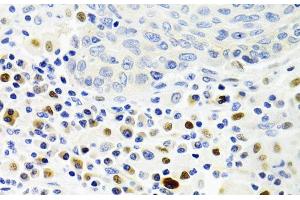 Immunohistochemistry of paraffin-embedded Human lung cancer using GEMIN2 Polyclonal Antibody at dilution of 1:100 (40x lens). (SIP1 antibody)