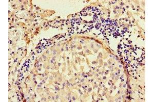 Immunohistochemistry of paraffin-embedded human lung cancer using ABIN7144308 at dilution of 1:100 (Anoctamin 4 antibody  (AA 1-200))