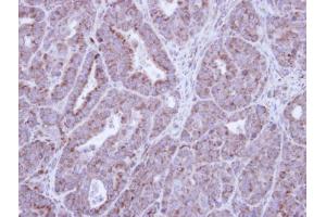 IHC-P Image Immunohistochemical analysis of paraffin-embedded NCIN87 Xenograft , using HAX1, antibody at 1:100 dilution. (HAX1 antibody)