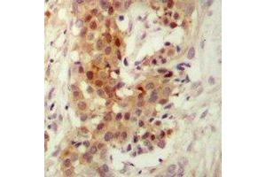 Immunohistochemical analysis of PKC iota/zeta staining in human breast cancer formalin fixed paraffin embedded tissue section. (PKC iota/zeta antibody)