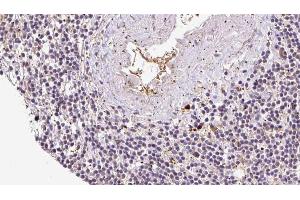 ABIN6273070 at 1/100 staining Human lymph cancer tissue by IHC-P. (RCN2 antibody  (C-Term))