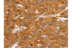 The image on the left is immunohistochemistry of paraffin-embedded Human liver cancer tissue using ABIN7130217(MED22 Antibody) at dilution 1/40, on the right is treated with fusion protein. (MED22 antibody)