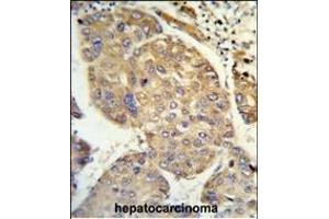 Formalin-fixed and paraffin-embedded human hepatocarcinoma reacted with PHACTR2 Antibody (N-term), which was peroxidase-conjugated to the secondary antibody, followed by DAB staining. (PHACTR2 antibody  (N-Term))