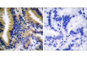 Peptide - +Immunohistochemical analysis of paraffin-embedded human breast carcinoma tissue using BIK (Ab-33) antibody (#B0053).