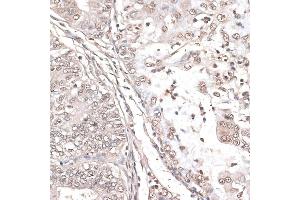 Immunohistochemistry of paraffin-embedded human endometrium cancer using MEF2C antibody (ABIN6132345, ABIN6143716, ABIN6143717 and ABIN6215998) at dilution of 1:100 (40x lens). (MEF2C antibody  (AA 170-380))