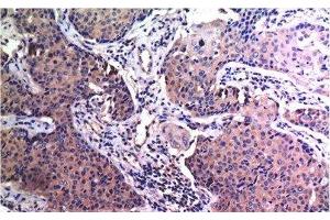 Immunohistochemistry of paraffin-embedded Human breast carcinoma tissue using MMP2 Monoclonal Antibody at dilution of 1:200. (MMP2 antibody)