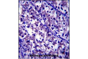 LB1 Antibody (C-term) (ABIN657904 and ABIN2846855) immunohistochemistry analysis in formalin fixed and paraffin embedded human kidney carcinoma followed by peroxidase conjugation of the secondary antibody and DAB staining. (Laminin beta 1 antibody  (C-Term))