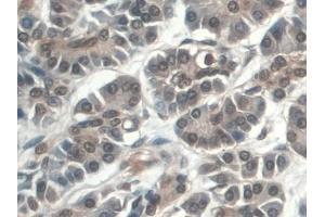 Detection of C5a in Human Pancreatic cancer Tissue using Monoclonal Antibody to Complement Component 5a (C5a) (C5A antibody  (AA 678-751))