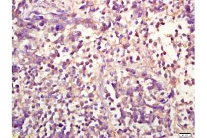 Formalin-fixed and paraffin embedded human lung carcinoma labeled with Anti-phospho-ERK1(Thr202/Tyr204) +ERK2(Thr183/Tyr185) Polyclonal Antibody, Unconjugated (ABIN732458) at 1:200 followed by conjugation to the secondary antibody and DAB staining (ERK1/2 antibody  (pThr183, pTyr185))