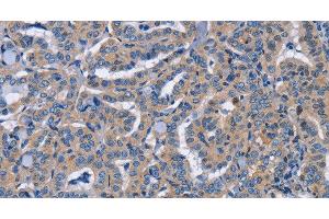 Immunohistochemistry of paraffin-embedded Human thyroid cancer tissue using NCR2 Polyclonal Antibody at dilution 1:60 (NKp44/NCR2 antibody)