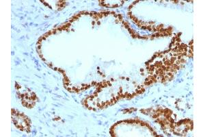 Formalin-fixed, paraffin-embedded human Prostate Carcinoma stained with FOXA1 Monoclonal Antibody (FOXA1/1241). (FOXA1 antibody  (AA 372-472))