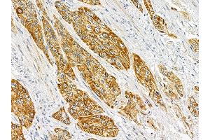 ABIN6262367 and ABIN6278302 at 1/100 staining human esophageal cancer by IHC-P.
