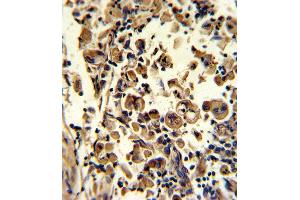 Formalin-fixed and paraffin-embedded human lung carcinoma reacted with SOD3 Antibody (N-term), which was peroxidase-conjugated to the secondary antibody, followed by DAB staining. (SOD3 antibody  (N-Term))