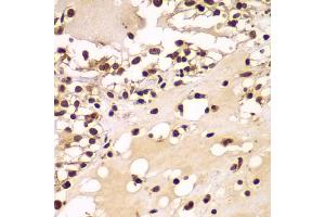 Immunohistochemistry of paraffin-embedded human kidney cancer using ZNF20 antibody (ABIN5975115) at dilution of 1/100 (40x lens). (ZNF20 antibody)