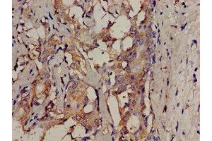 Immunohistochemistry analysis of human breast cancer using ABIN7174064 at dilution of 1:100 (SRMS antibody  (AA 19-155))