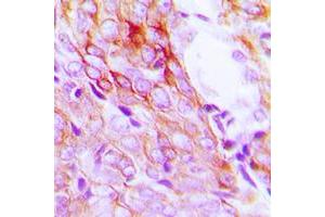 Immunohistochemical analysis of EGFR staining in human breast cancer formalin fixed paraffin embedded tissue section.