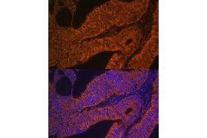 Immunofluorescence analysis of human colon carcinoma using RB antibody (ABIN6128601, ABIN6146597, ABIN6146598 and ABIN6223325) at dilution of 1:100. (RAB5B antibody  (AA 1-215))