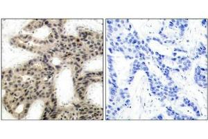 Immunohistochemical analysis of paraffin-embedded human breast carcinoma tissue using 4E-BP1(Phospho-Thr45) Antibody(left) or the same antibody preincubated with blocking peptide(right). (eIF4EBP1 antibody  (pThr45))