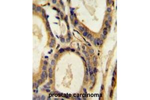 CCL4 Antibody (Center) immunohistochemistry analysis in formalin fixed and paraffin embedded human prostate carcinoma followed by peroxidase conjugation of the secondary antibody and DAB staining. (CCL4 antibody  (Middle Region))