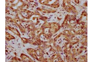 IHC image of ABIN7165570 diluted at 1:400 and staining in paraffin-embedded human liver cancer performed on a Leica BondTM system. (FAM83G antibody  (AA 464-615))